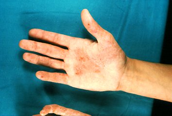 Que sanar para siempre la psoriasis