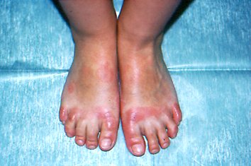 Que sanar la psoriasis una vez para siempre
