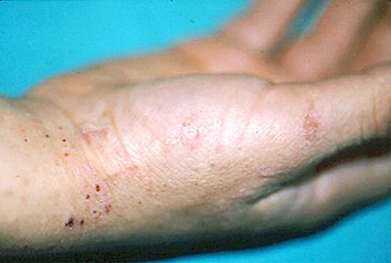 Como es posible vencer la psoriasis