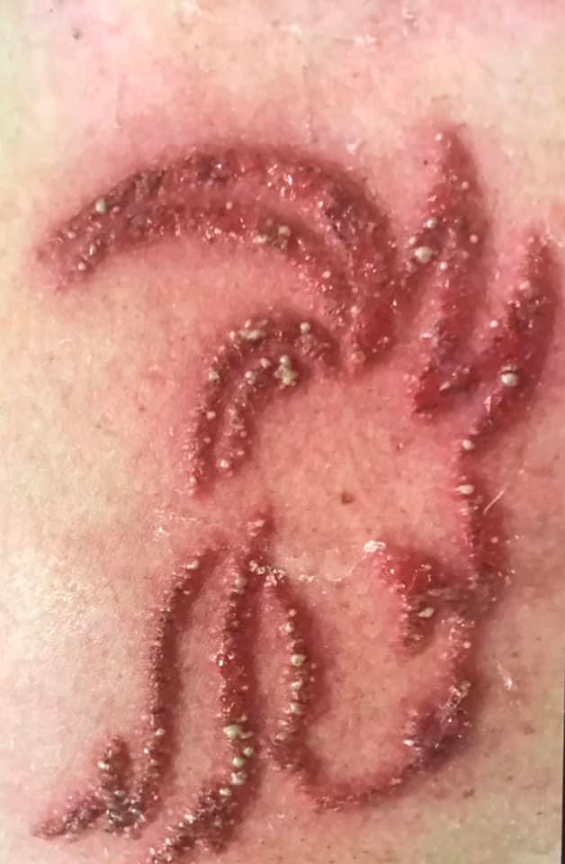 Alergia a la henna