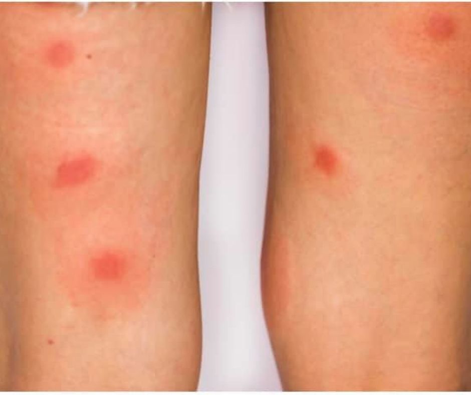 urticaria papular