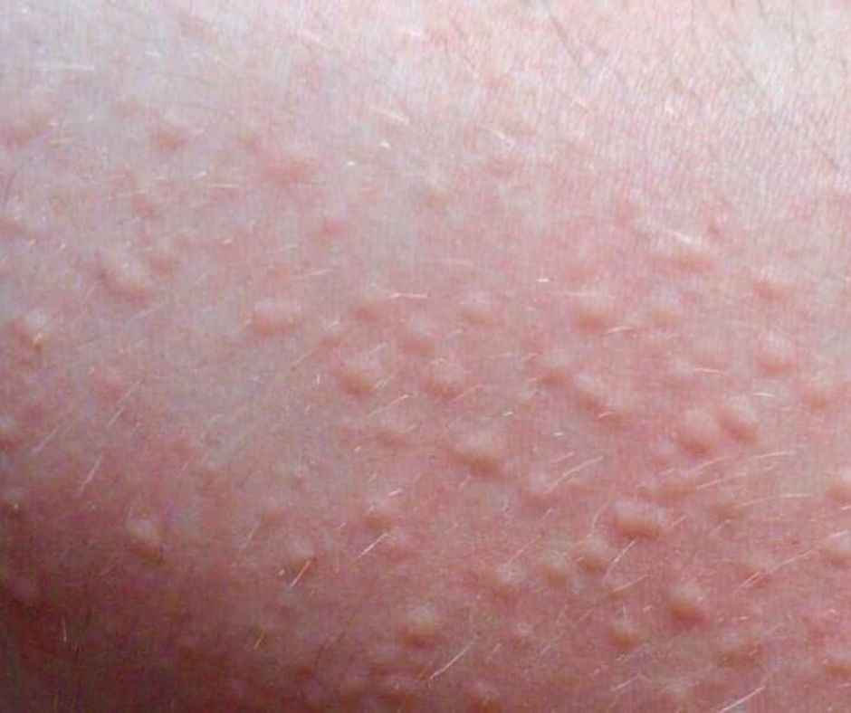 urticaria