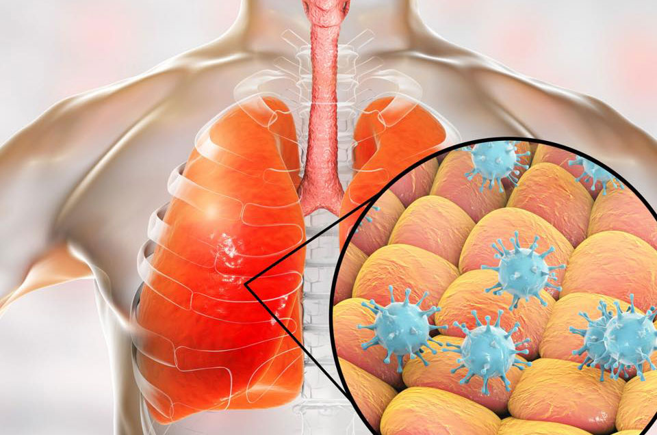 Coronavirus (COVID-19): lo que las personas con asma deben saber
