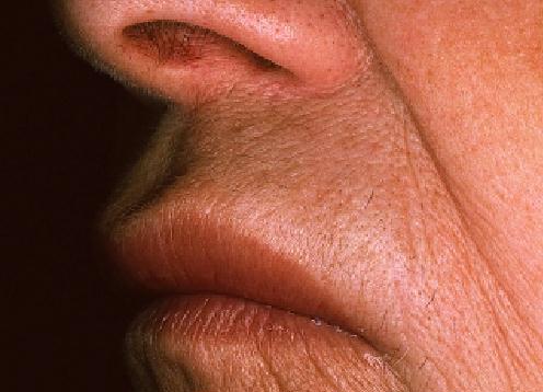 Angioedema Hereditario