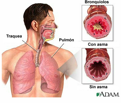 Qué sucede durante un episodio de asma