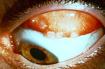 Queratoconjuntivitis vernal