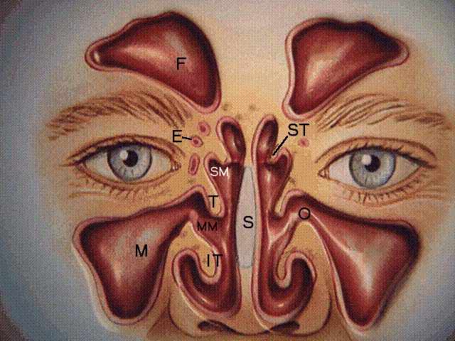 Sinusitis