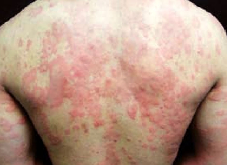 Urticaria y angioedema